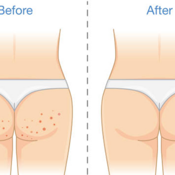 Common Causes of Butt Acne