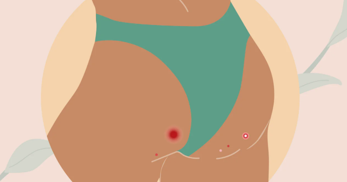 Say Goodbye to Butt Pimples: 5 Easy Skin Care Tips