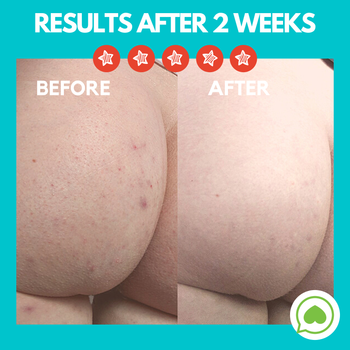 Before and after of butt skin with reduced acne and bumps